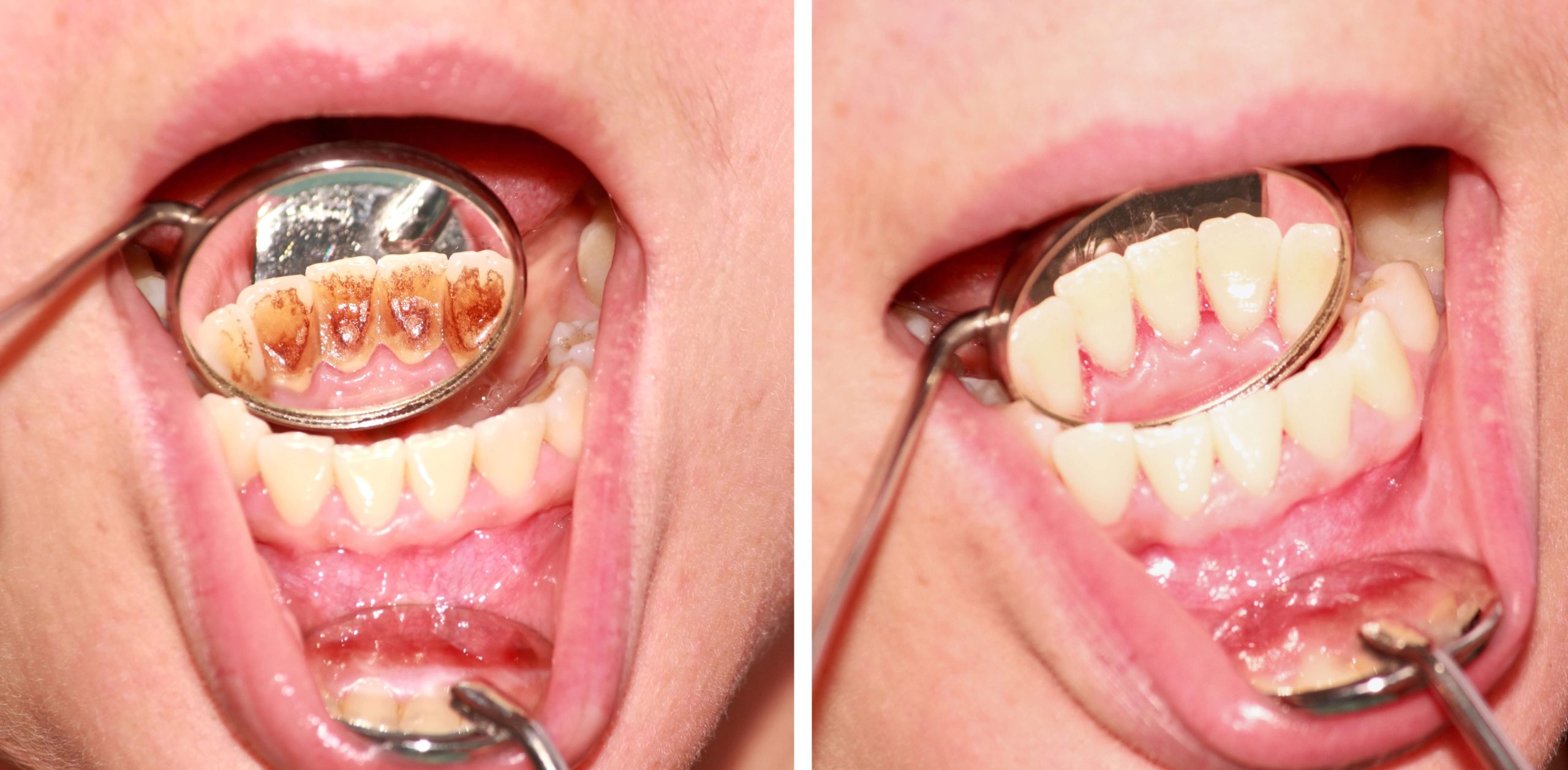 Deep Cleaning & Tartar Removal