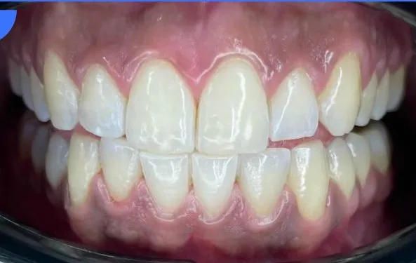 Professional Teeth Whitening — After
