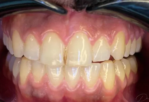 Professional Teeth Whitening — Before